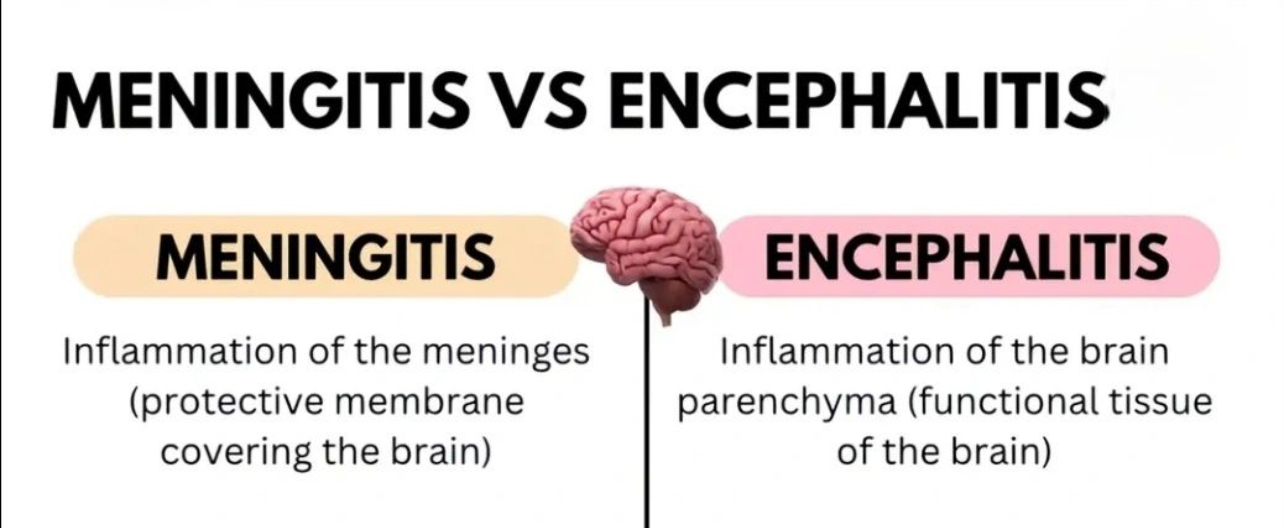 You are currently viewing MENINGITIS VS ENCEPHALITISMeningitis and encephalitis are both serious conditions involving inflammation in the brain.